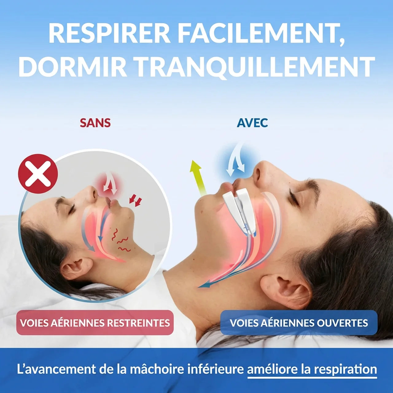Gouttière Anti-Ronflement Ajustable